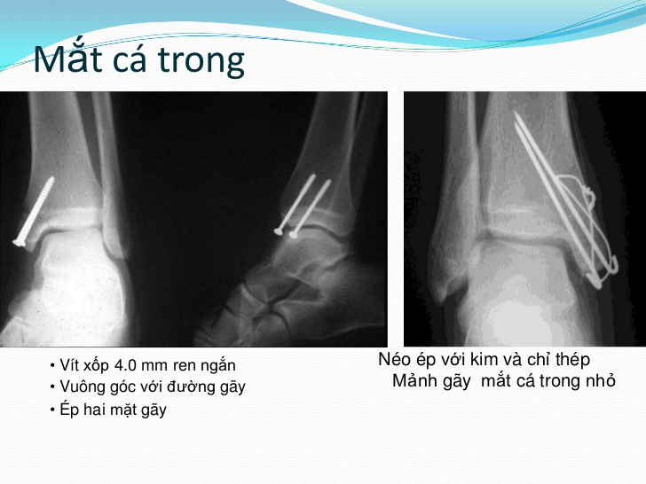 Gãy mắt cá chân - Hình ảnh minh họa